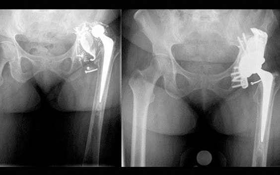 X-ray of a patient's hip with and without an aMace hip implant