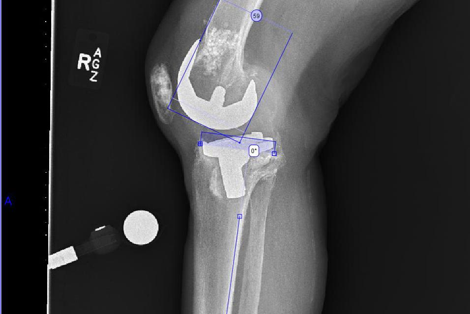 Side X-ray image of the patient's knee pre-op