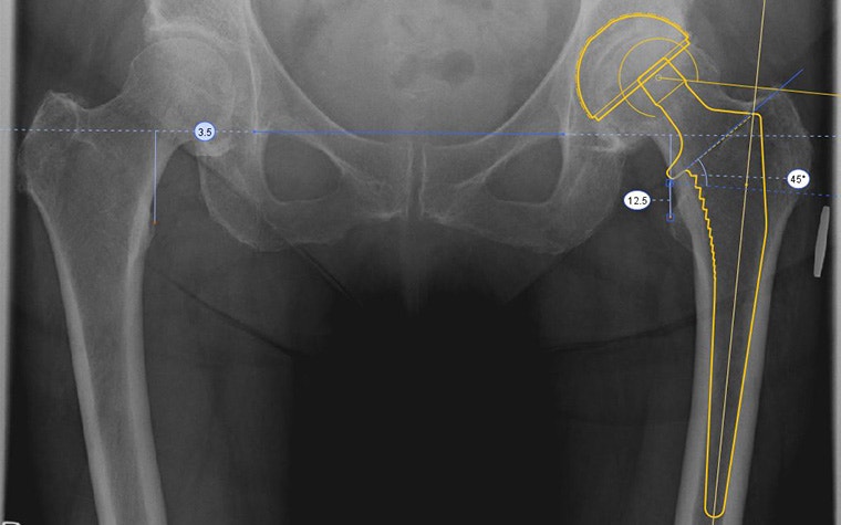 X-ray of a patient's hips with an overlay of a hip implant and measurements