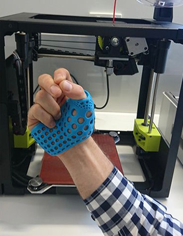 Personalized, 3D-printed thumb splint on a hand in a fist