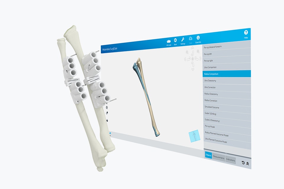 ssd-planning-guides-osteotomy-render.jpg