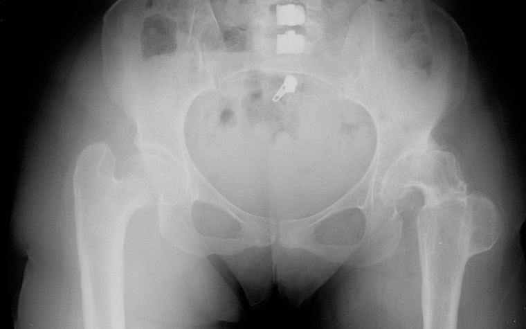 Preoperative X-ray of the patient’s pelvis