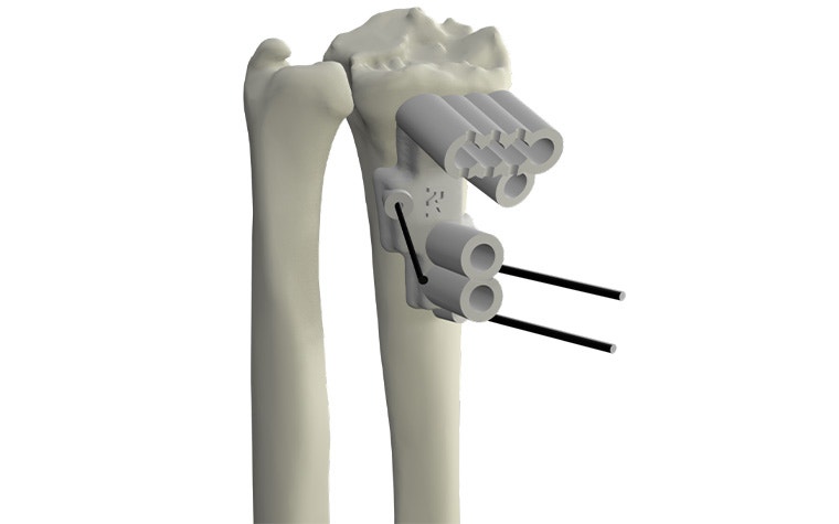 materialise-osteotomies-solutions-3d-printed-guides-indication-wrist-model.jpg