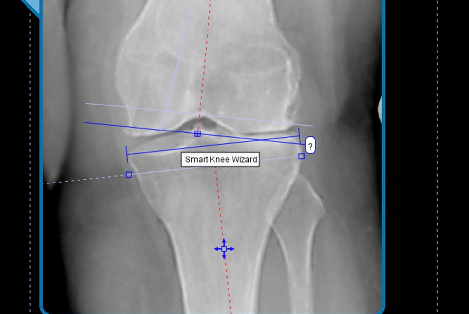 X-ray image of a knee in OrthoView software