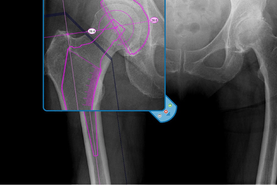 X-ray of a pelvis in OrthoView software