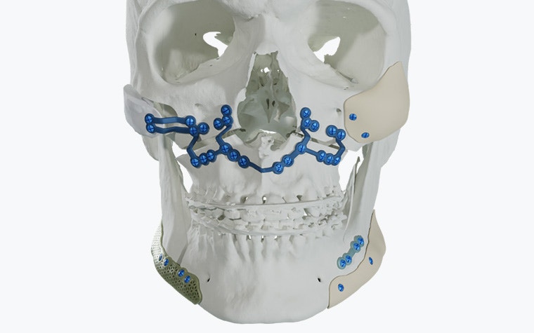 Ein Schädel mit 3D-gedruckten Titanimplantaten von Materialise auf weißem Hintergrund.