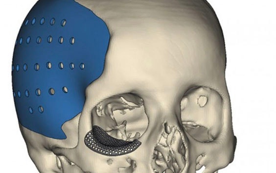 How to Design a Patient-Specific Cranial Plate