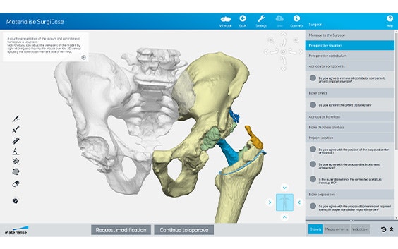 3D digital model of a pelvis with one hip and upper leg in color
