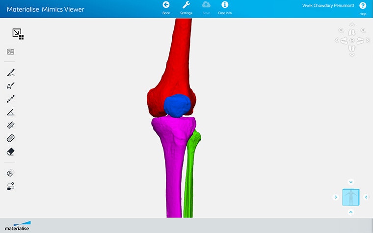 Screenshot of Materialise Mimics Viewer showing segmented knee anatomy