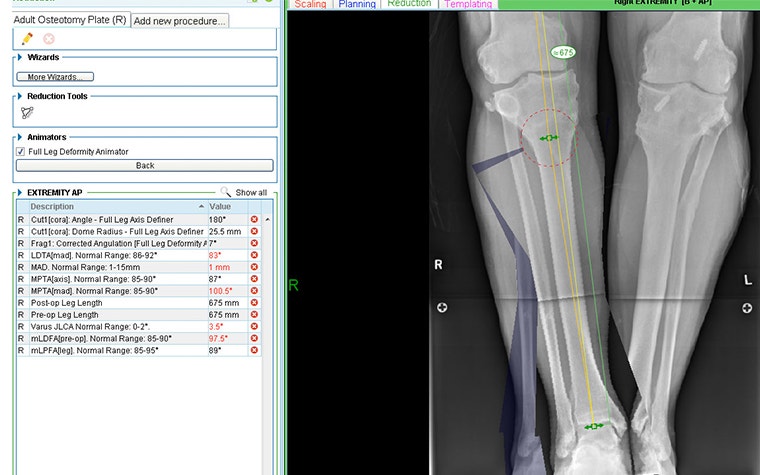 Surgical planning on lower legs in OrthoView