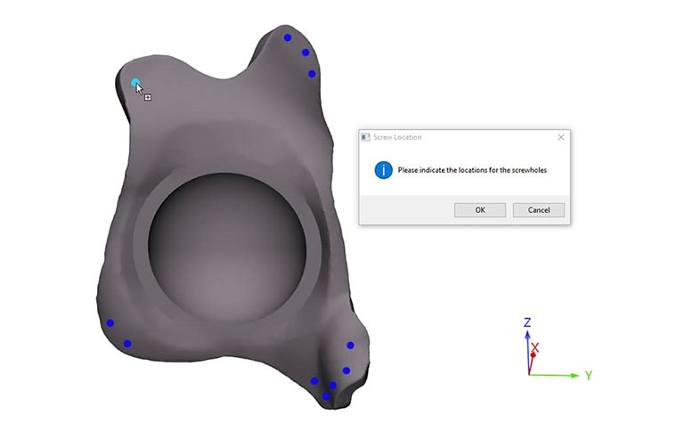 Personalized hip implant in medical software with screw locations marked