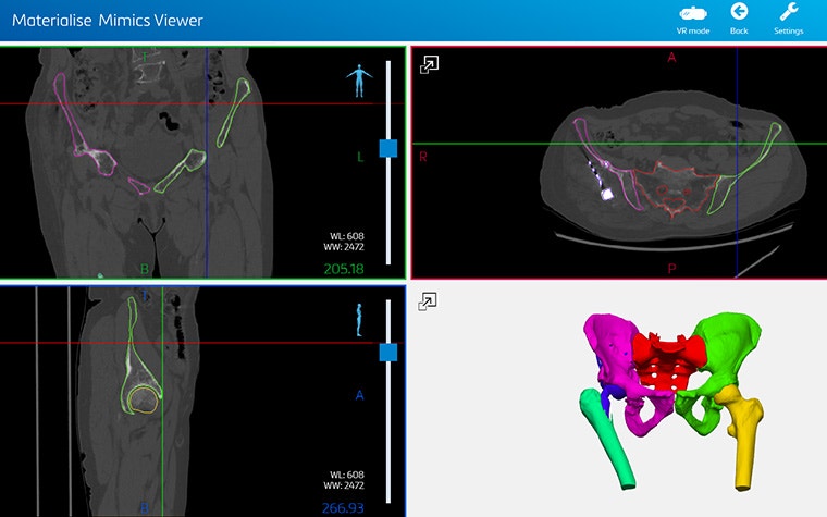 Segmentation of a hip shown on patient scans and a 3D model of hip anatomy in Mimics Viewer