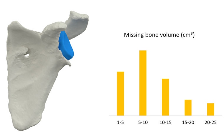 Virtual model of a shoulder with a blue block in place of a potential implant next to a graph showing varying missing bone volume (cm³)