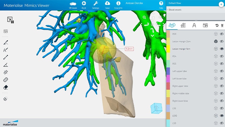Screenshot of the Mimics Viewer software, showing measurements on a part of lung anatomy