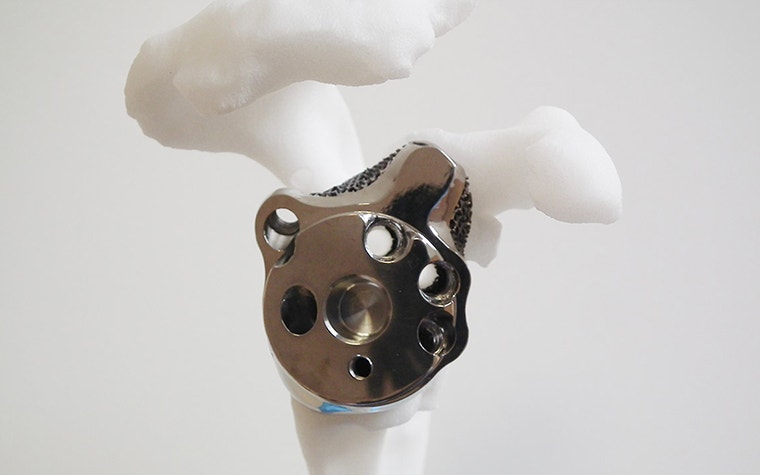 Metal 3D printed personalized shoulder implant 