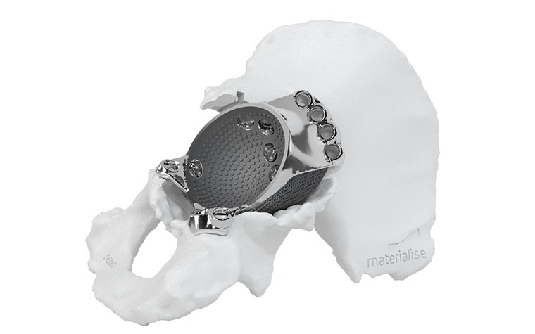 3D-printed hip implant attached to a model skeleton