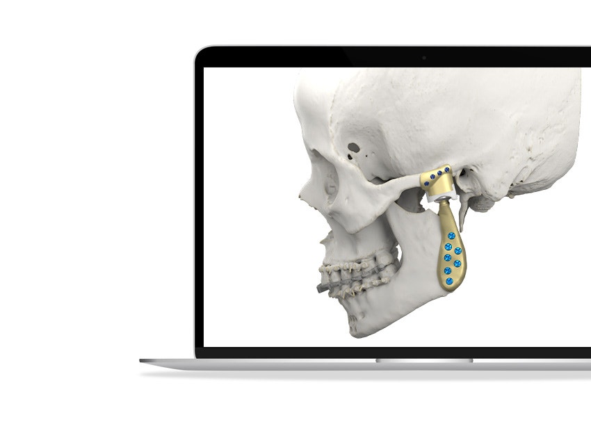 ssd-cmf-tmj-skull-custom-made-3d-printed-prosthesis-render.jpg