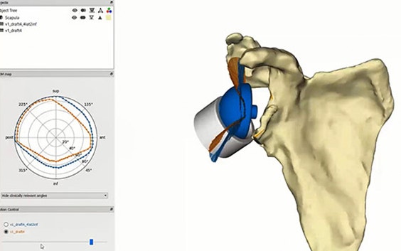 Planning a Glenius Personalized Shoulder Implant with the Clinical Engineer