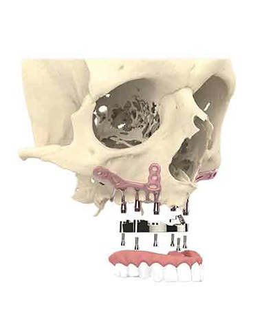 Side view of a skull model with implants that attach teeth to the skull