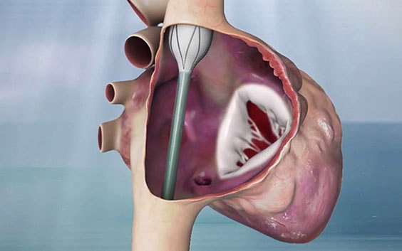 Digital image of a valve replacement