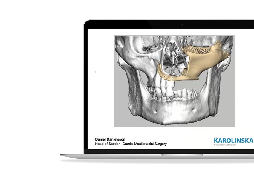 ssd-skull-orthognathic-surgery-3d-printed-model.jpg