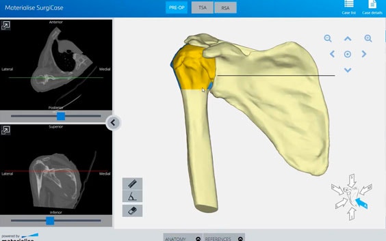 A Platform for Online 3D Planning and Ordering of 3D-Printed Shoulder Guides 