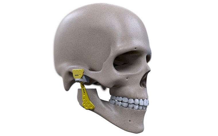 Engimplan implants for the jaw