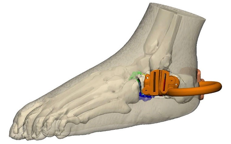 Digital model of a foot with a personalized instrument attached at the ankle, viewed from the side