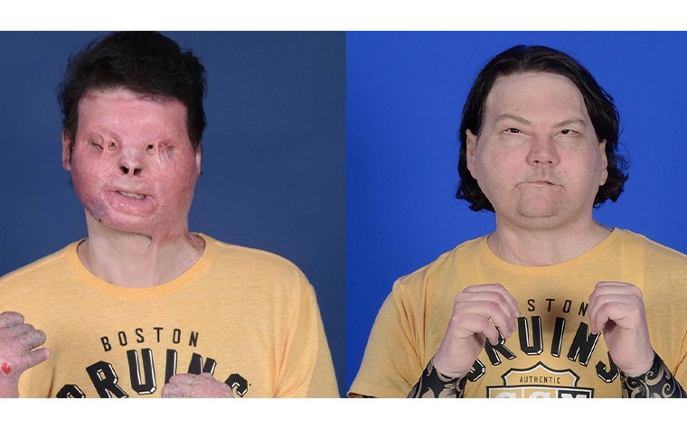 Man before and after receiving a double hand and face transplant