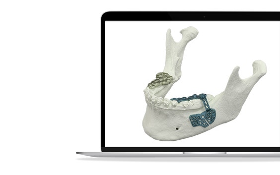 Laptop screen with a model of a lower jaw with personalized metal implants attached