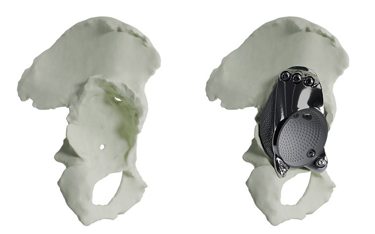 complete-acetabular-rim-loss-without-with-implant-model.jpg