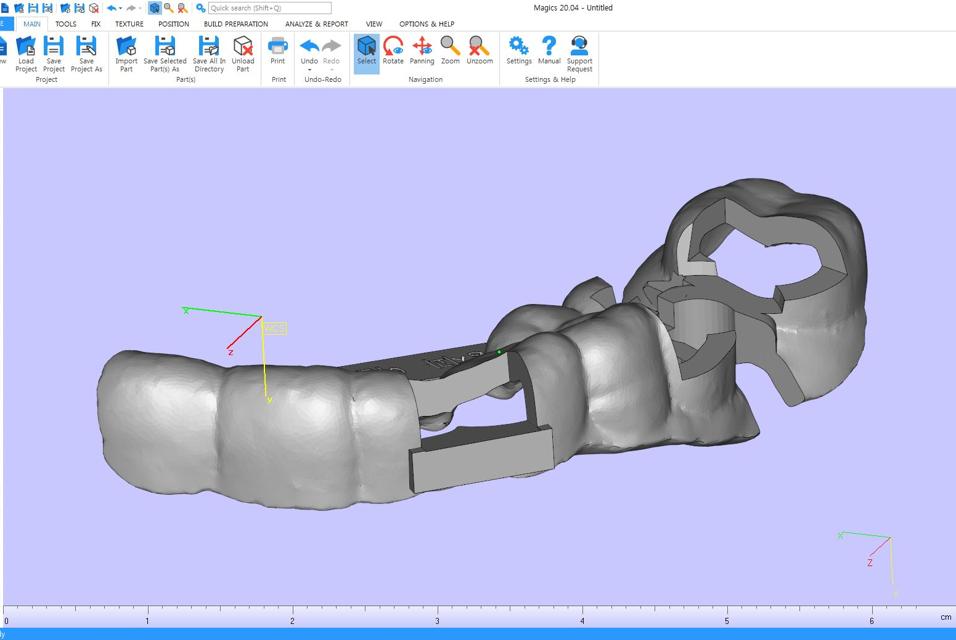3D model of a dental implant in Magics