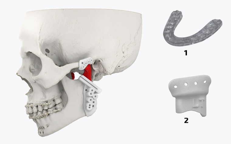 A skull with 3D-printed surgical guides shown on it and along side it.