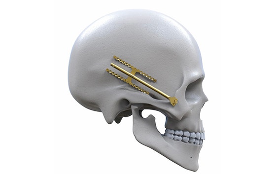 Engimplan implants in the skull