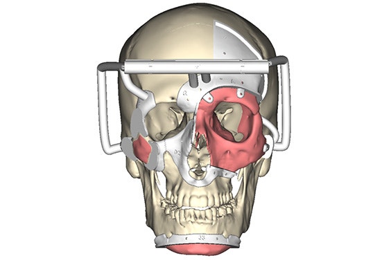 Digital image of personalized surgical guides on the donor's skull