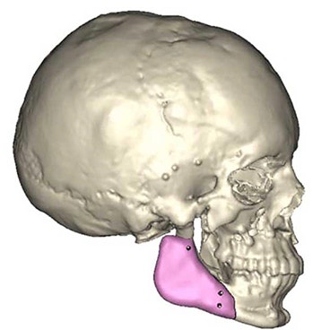 Revolutionizing Cranio-Maxillofacial Surgeries with 3D Planning and Custom Implant Design