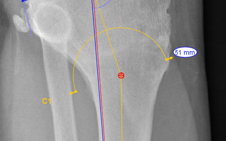 Measurements on a knee joint X-ray