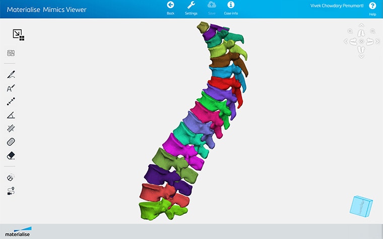 Screenshot of Materialise Mimics Viewer showing segmented spine anatomy