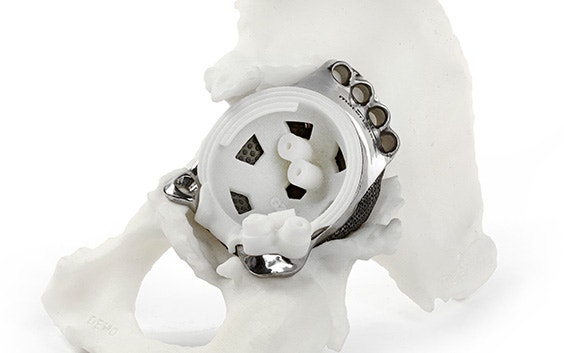 3D-printed metal hip implant in a hip model with a 3D-printed surgical guide inside