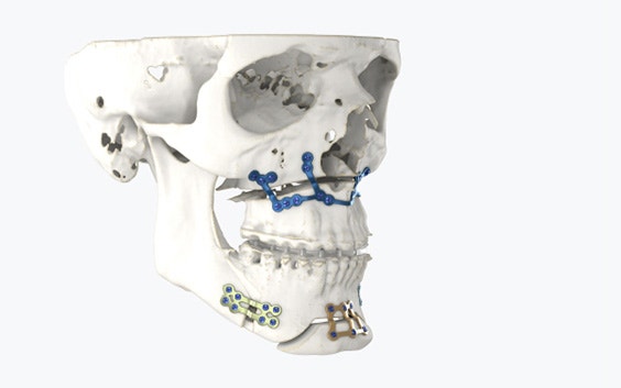 Side view of a skull with 3D-printed surgical implants