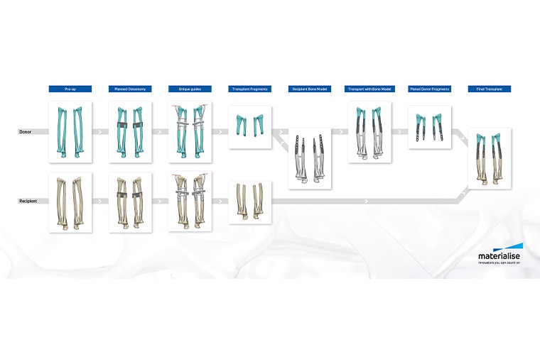 Graphic showing the surgical flow of a complicated procedure