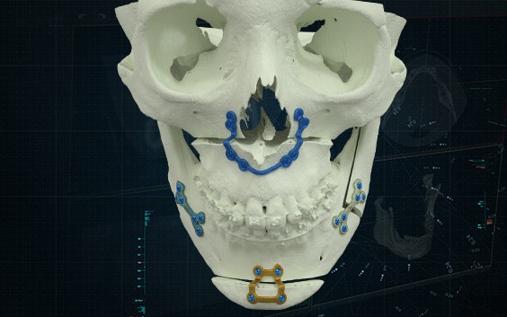 A skull model with personalized titanium plates attached