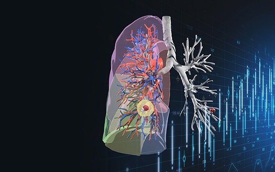 Digital 3D model of a patient's airways, segmented in difference colors, on a graph-like background