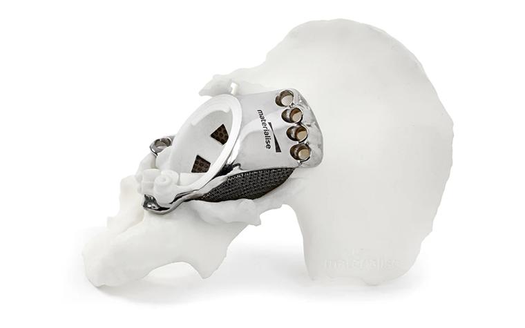 Metal 3D-printed aMace implant in a hip model