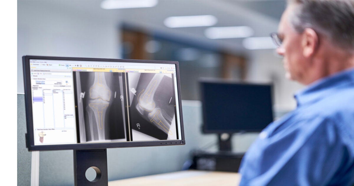 Video: How to Plan a Total Hip Arthroplasty in Less than 60 Seconds