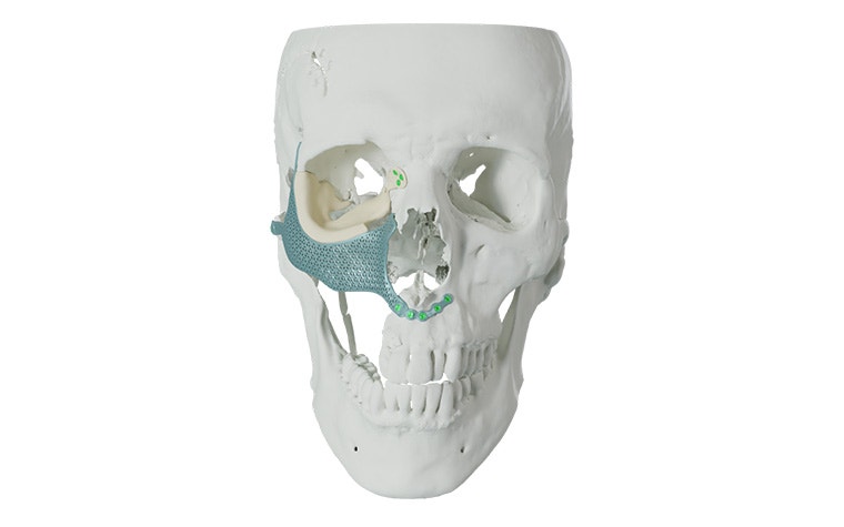 A front-facing skull with 3D-printed titanium implant for an orbital floor reconstruction.