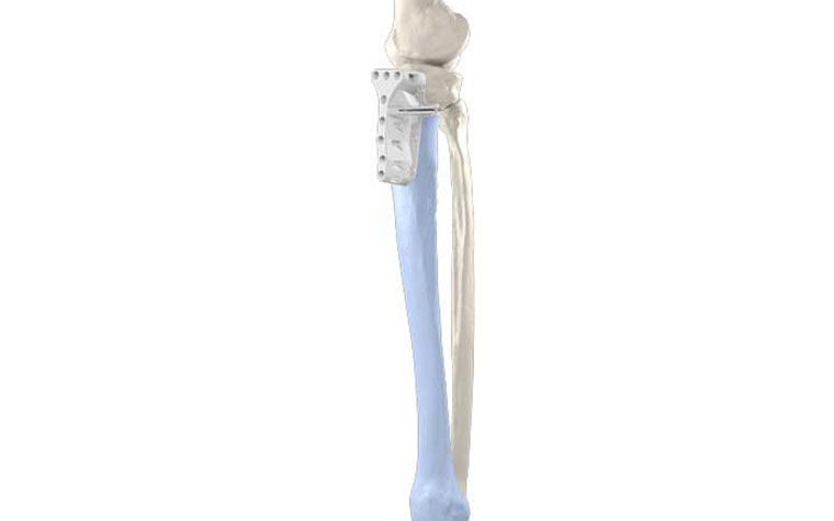 Digital image of a leg bone with a 3D-printed surgical guide attached