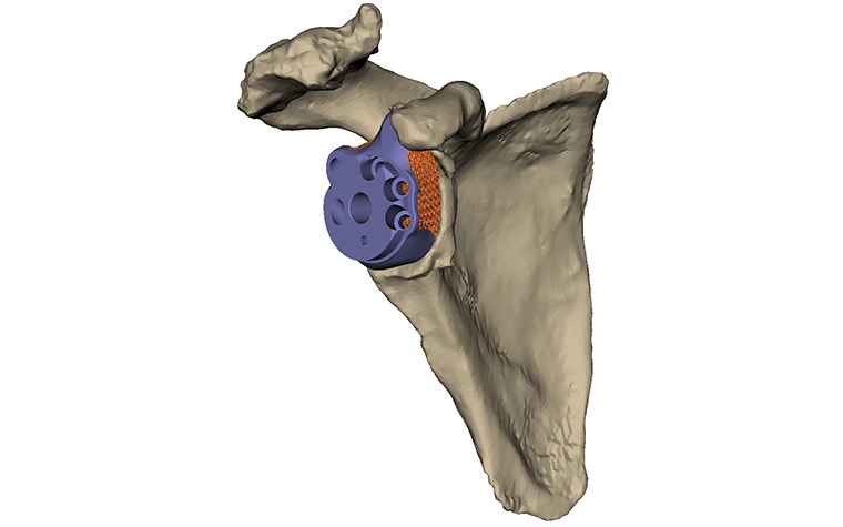 Computer model of personalized shoulder implant 