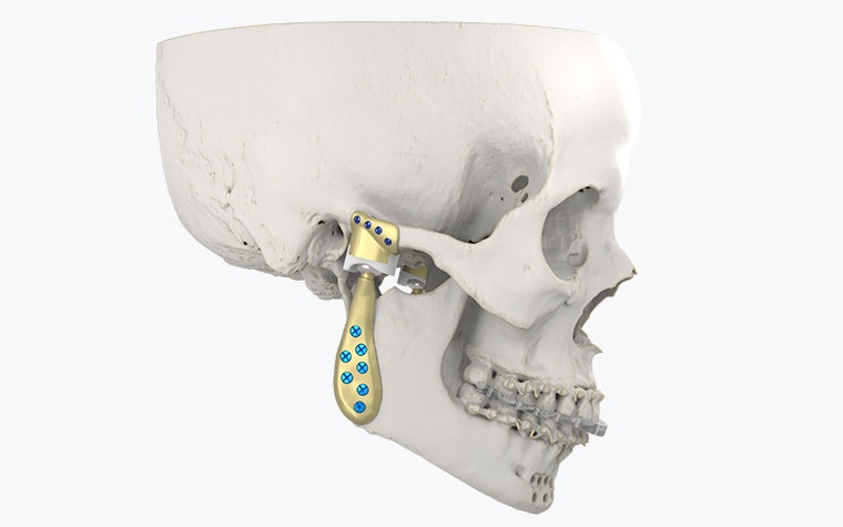 Side view of a skull with personalized implants attached to the jaw