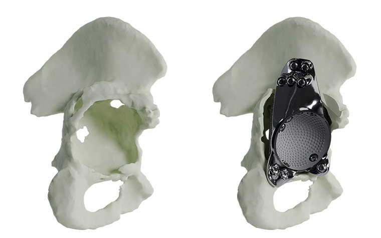 extensive-acetabular-without-with-implant-model.jpg